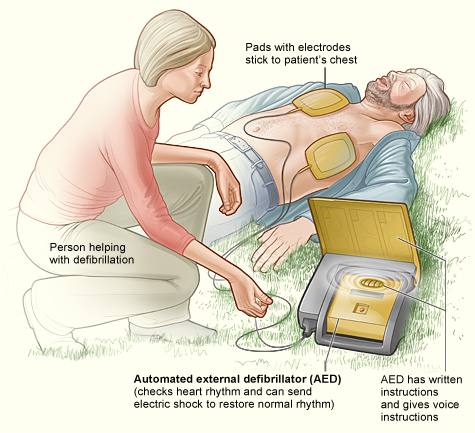 Automated External Defibrillator - Typical Setup
